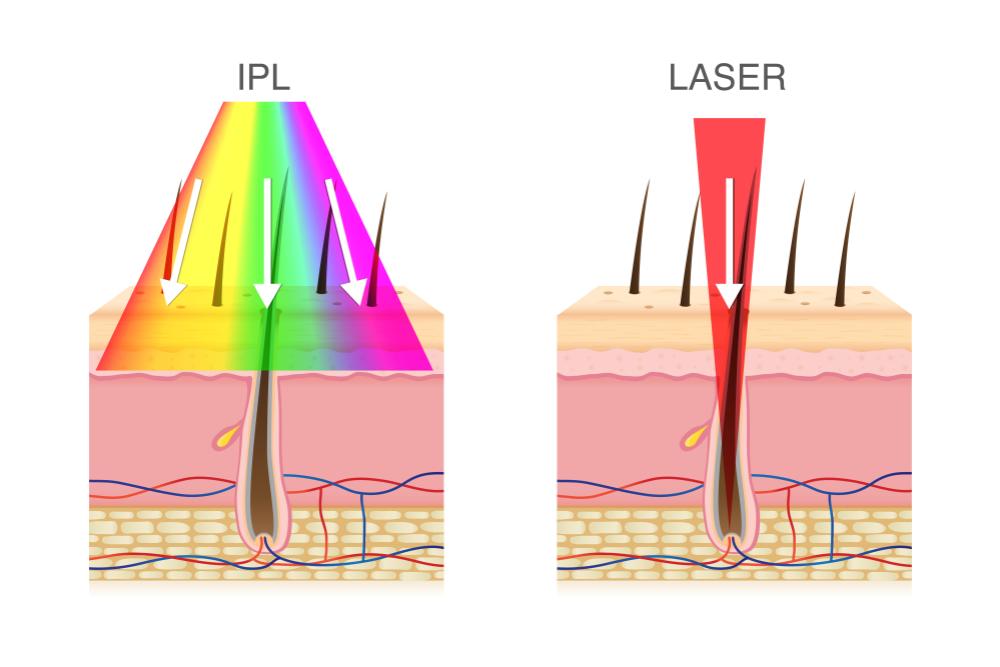 Epilation Laser Professionnelle - Epil Pro II : Appareil D’épilation ...